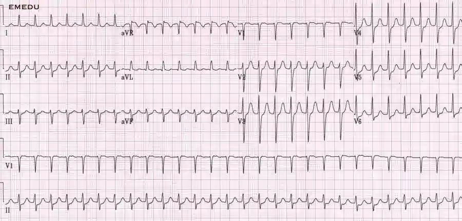 نحوه گرفتن نوار قلب (ECG)؛ راهنمای کامل و کاربردی